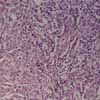 breast cancer cells