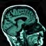 MRI scan of human brain