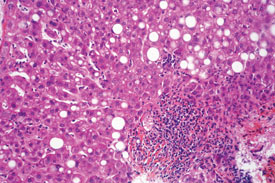 GSK snaps up hepatitis expert