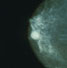 Mammogram