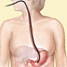 Cartoon of endoscope in stomach