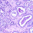 cancer cells
