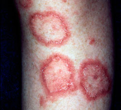 Lupus lesions