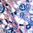 Cancer drugs for the next decade unveiled