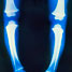 Rickets