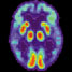 alzheimers-brain-scan