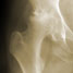 Bone disease