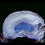 swollen hydrogel implant