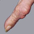 Gouty joint