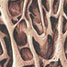 Diseased bone tissue from osteoporosis
