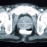 Prostate Cancer