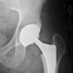 artificial hip