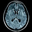 MRI scan