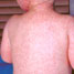 A child with measles