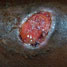 Buruli ulcer