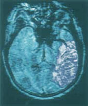Brain of a stroke patient