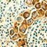 Breast cancer cells