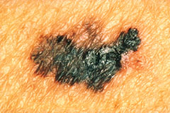 melanoma blemish
