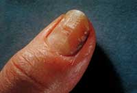 Finger Nail Fungus