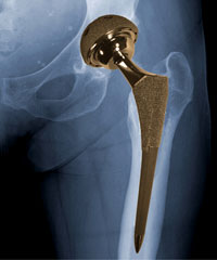 Hip joint replacement