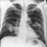 Early lung cancer diagnosis